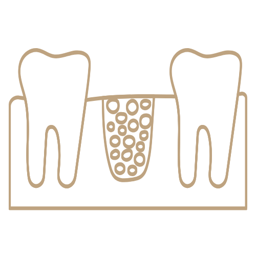 Bone Grafting