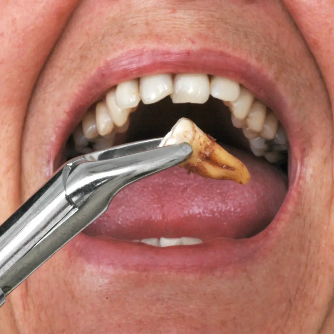 Simple Tooth Extractions